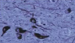 正常人：黑质神经元存在