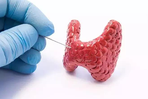 甲状腺疾。鬃聪俟δ芗跬撕图鬃聪俟δ芸航，自古以来就是反复被医学研究人员研究的疾病