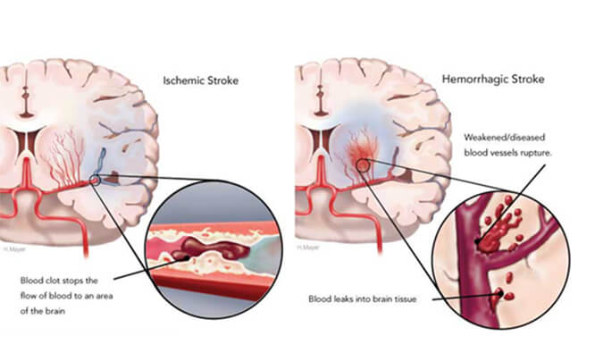 世界卒中日：从动物药效模型评价看心脑血管药物开发